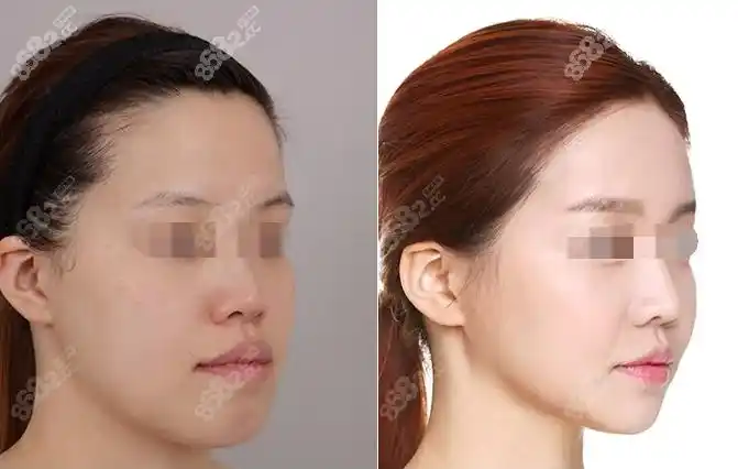 周会喜正颌对比图