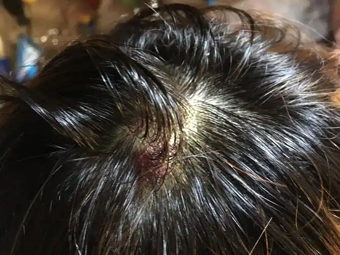 头上有个包去医院做了头部ct结果是皮下血肿第二天出现了一块暗红色的