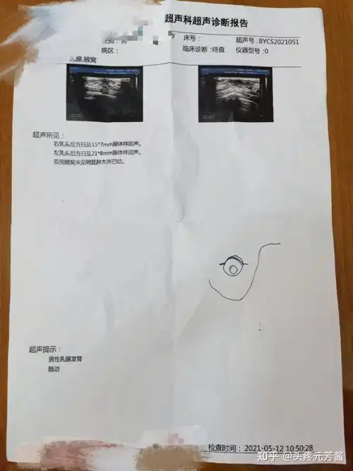 男性乳腺增生手术