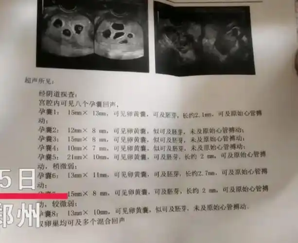 上了热搜,这位女子在开始怀孕做检查的时候,医生就发现了是"6个孕囊"