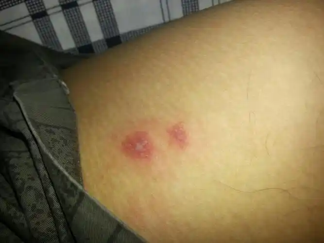 腿上长了两个痘痘,摸上去有轻微的痛感,不痒,请问