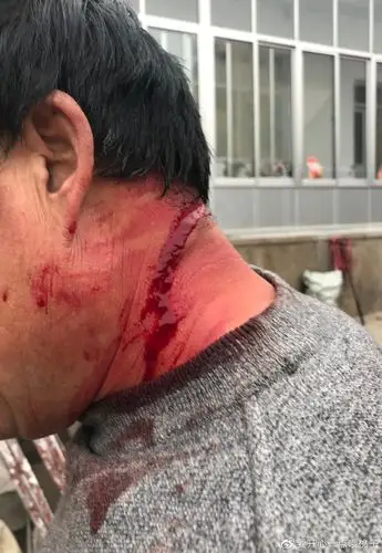 我爸脖子的刀伤