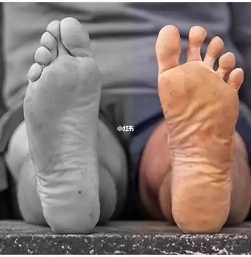 畸形的脚和健康的脚,对号入座看看自己是哪种.