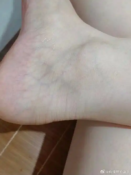 今天穿拖鞋,朋友看到我脚说我血管怎么这么明显,她的就没有,手机查了