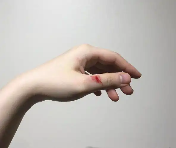 4个小时后 又发生了流血事件对胶布严重过敏 不能用创可贴 今天洗不了