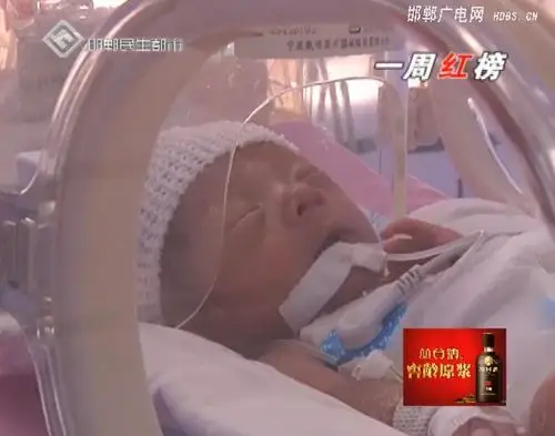 邯郸胎龄仅31周先天性心脏病早产儿成功手术