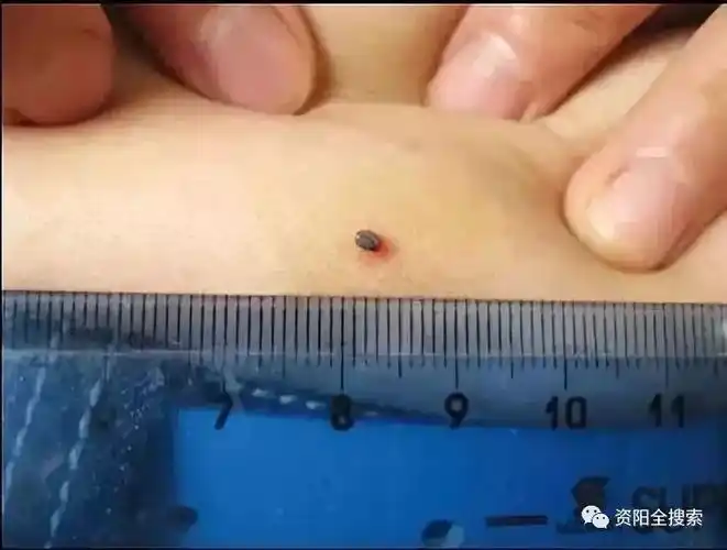 夺命蜱虫怎么破又到夏季身上冒出小黑点别大意