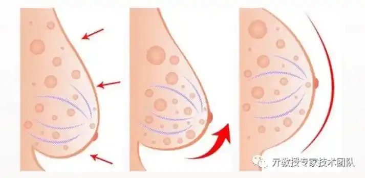 常见的乳房下垂分为哪几类_乳房萎缩_乳房萎缩介绍 - 好大夫在线