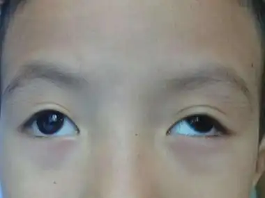 恒定性外斜视的症状和图片 - 有来医生