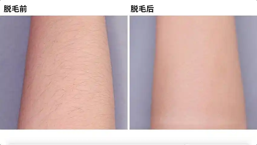 脱毛前后对比图