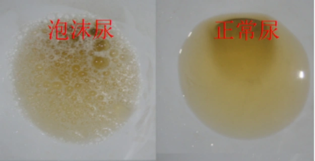 01尿中泡沫增多早期慢性肾脏病容易被忽视,因为大多数患者没有出现不