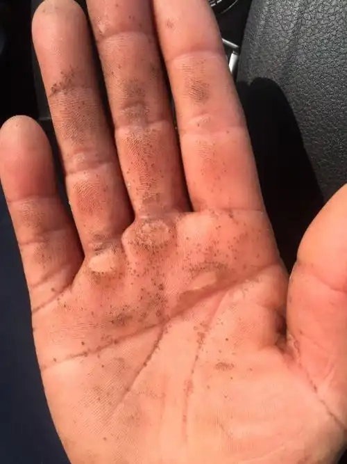 手掌怎么那么多洞洞