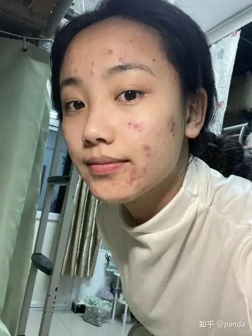 为什么满脸的痘痘去不掉,还总是反反复复的长?