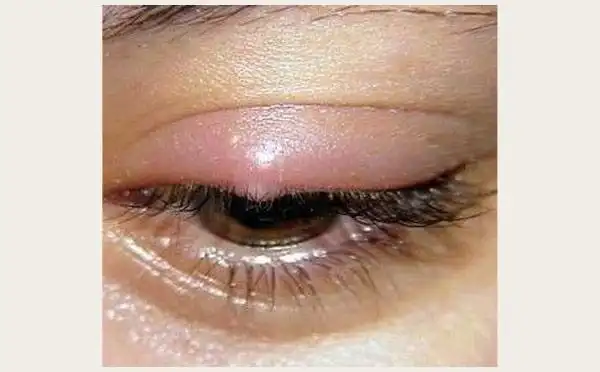 炎症性眼睑水肿