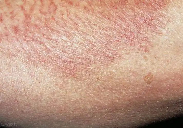 发现这是一种常见的问题,可能与肛门周围的皮肤湿热有关