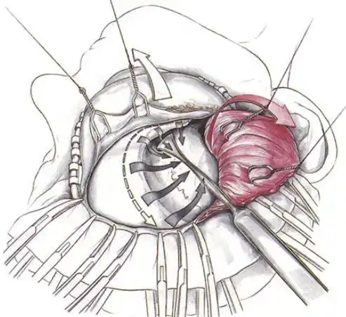 《经典重温》之翼点入路