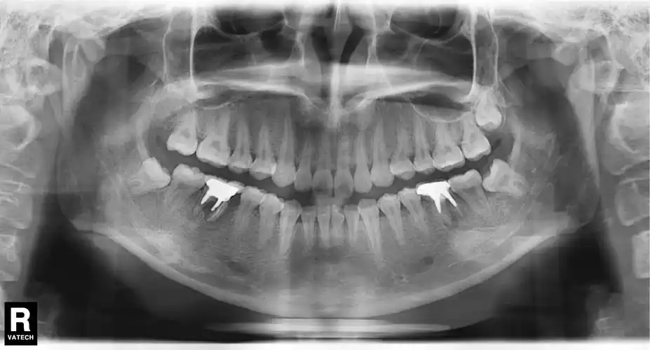 大牙牙龈下方长了个大包,不按不疼,大概两个月了,有的医生说是牙囊肿