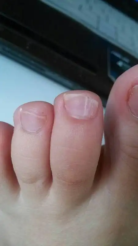 请问,为什我的指甲是两瓣的,从小就这样,可是最近好像另一半要努力张