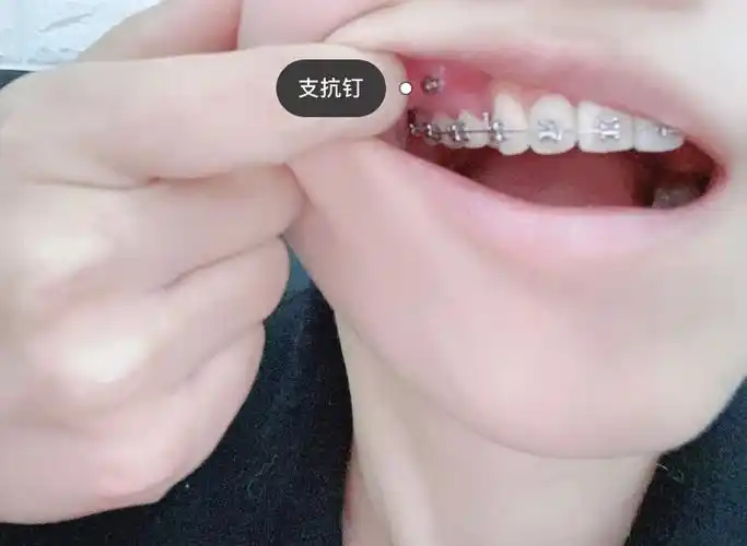 矫正牙齿上牙钉图片