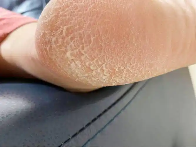 原创30岁生孩子后脚后跟干裂起硬皮该怎么办