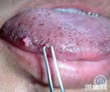 百分百!女性hpv病毒早期症状"满面春风"-第1张图片-普贤博客