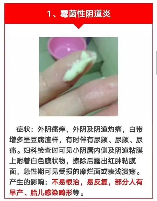 以上三种是阴道炎的白带,想要更详细的请看下面的文字: 22.