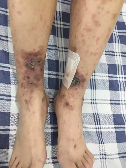 糖尿病的皮肤损害 - 好大夫在线