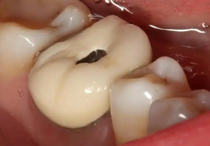 烤瓷牙出问题,如何不拆牙套治疗基牙! - 好大夫在线