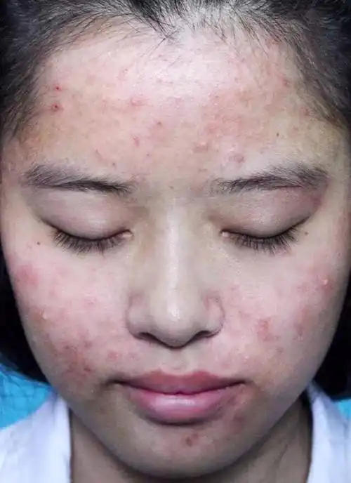 芦荟涂脸祛痘?医生道出真相:多做3事少吃2物,才能根除痘痘