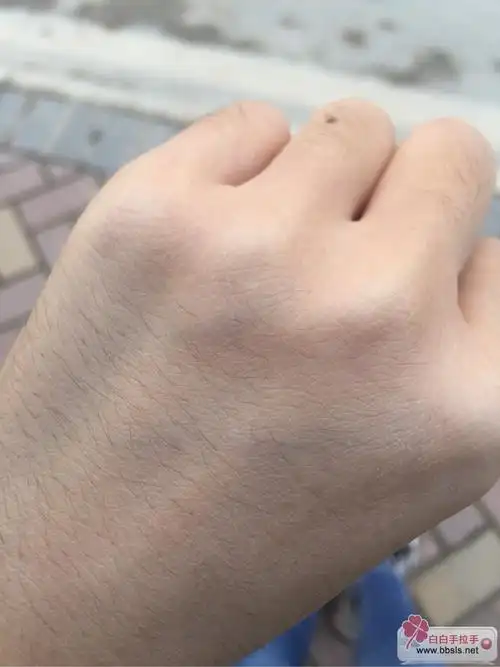 手背突然发现的三个白点
