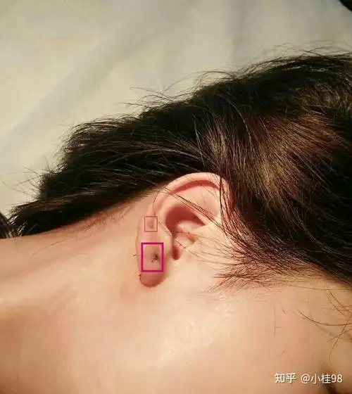 耳垂皮脂腺囊肿手术需要住院吗