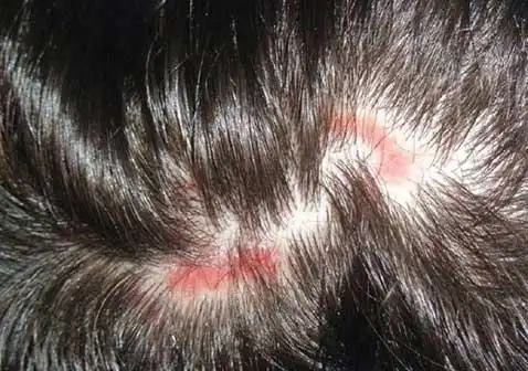 头皮皮肤病种类症状图片_银屑病求医网