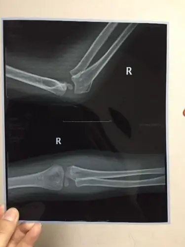 儿童手臂骨折保守治疗要吃药打针或者手术吗?