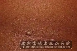 水瘊子发病原因介绍_疣_北京京城皮肤病医院(北京医保定点机构)