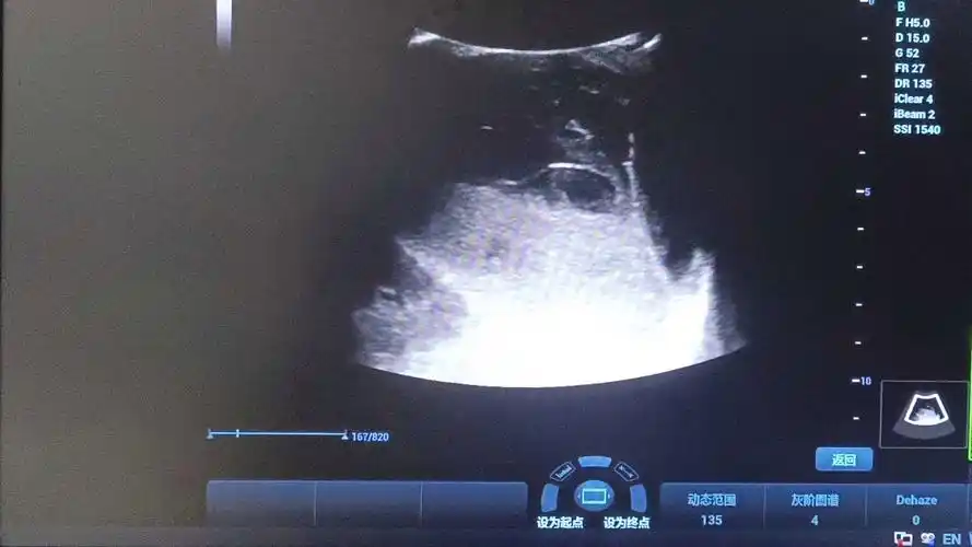 脾脏创伤性破裂一例