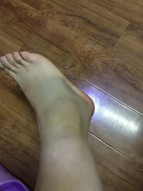 半个月前打羽毛球脚崴了扭住脚踝骨头没事就是肿了有淤血因为前几年同