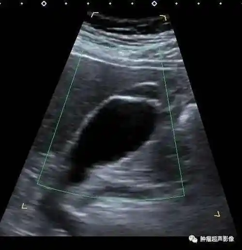 胆囊腺肌症的超声诊断