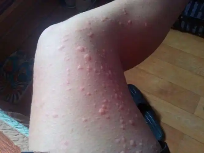 过敏荨麻疹的症状的图片