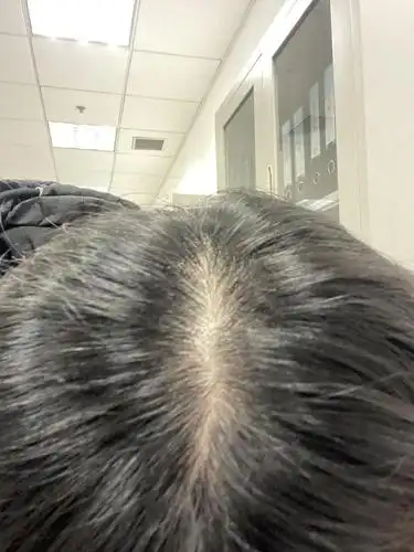 这样的头顶正常吗