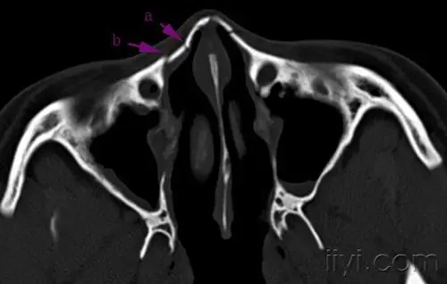 教科书式的鼻骨骨折!dr ct!
