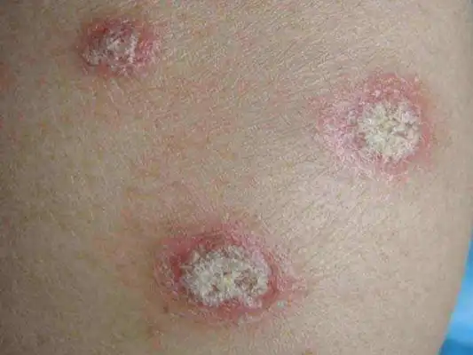 体癣初期图片 (51)