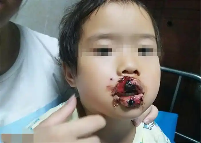 触目惊心!一四岁小女孩下嘴唇竟然被狗咬掉,伤口不忍直视!