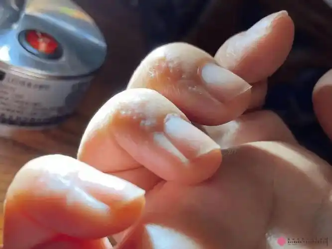 奇痒无比!夏天手上老长"小水泡"怎么办?会传染吗?