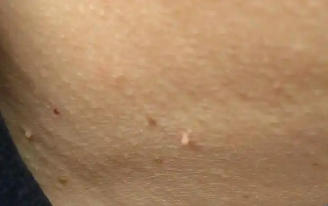 脖子和腋下长的"小肉粒"是什么?会影响健康吗?或需重视起来