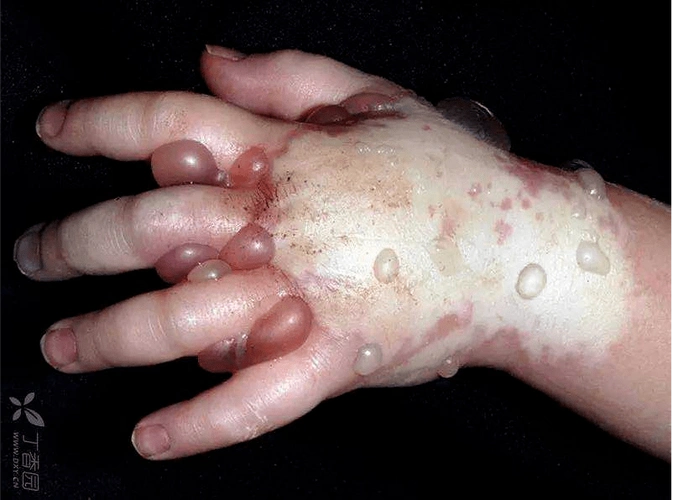 药物外渗的分级和预防_静脉_导管_化疗