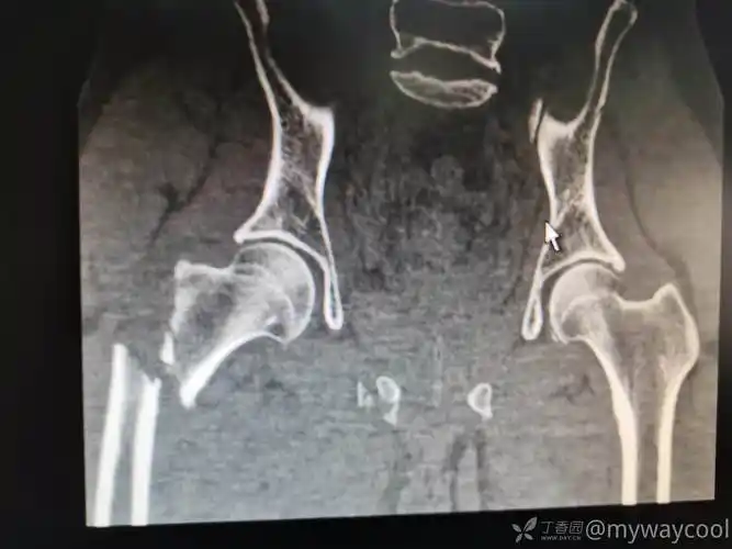 股骨近端粉碎骨折术前术后