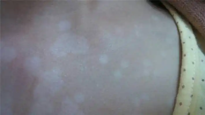 重庆花斑癣医院_重庆治疗花斑癣哪家医院好_重庆治疗花斑癣权威的医院