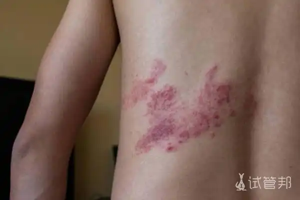 白色念珠菌感染症状是什么 会发生在哪些不同部位