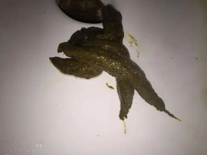 最近都不知道怎么了,慢性浅表性胃炎伴胆汁反流这么严重吗?