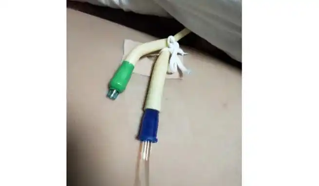 尿管固定别小看5cm,却是"血"的差距!